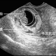 什么是孕囊？孕囊的作用是什么,胎儿发育胎囊图片