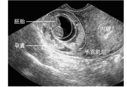 什么是孕囊？孕囊的作用是什么,胎儿发育胎囊图片
