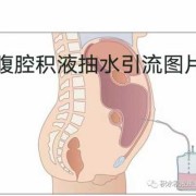 胎儿腹腔积水（腹腔积水该怎么治疗）