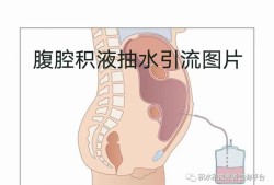 胎儿腹腔积水（腹腔积水该怎么治疗）