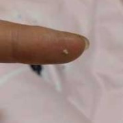 哺乳期乳头出现白色颗粒怎么回事,孕期乳头上有白色的是什么