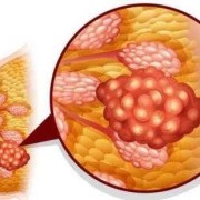 为什么生了孩子的女人身材丰腴,孕期大乳腺结节