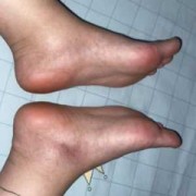 孕期脚板痛（孕期脚板痛正常吗）