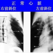 胎儿右心大（胎儿右心大于左心正常吗?）