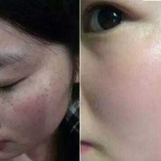 如何防止孕期长斑（如何防止孕期长斑暗黄）
