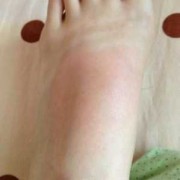 孕期脚面痒的难受怎么办,孕期脚面疼是怎么回事
