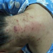 孕期脖子长痘（孕期脖子长痘痘是什么原因）
