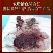 胎儿输血综合征（胎儿输血综合征）