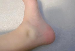 孕期全身肿（孕期全身肿的连脸都不放过）