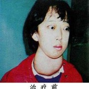 请问大家甲亢对胎儿智力的影响大吗,孕期甲亢胎儿聪明的表现