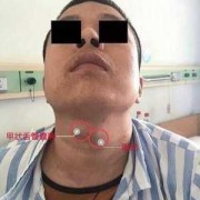 胎儿舌囊肿（那请问甲舌囊肿是怎么回事）