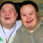 唐氏综合征是什么引起的,唐氏胎儿怎么引起的
