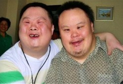 唐氏综合征是什么引起的,唐氏胎儿怎么引起的