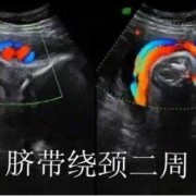 超声对胎儿的影响（超声对胎儿的影响有哪些）