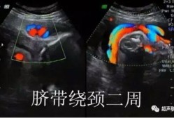 超声对胎儿的影响（超声对胎儿的影响有哪些）