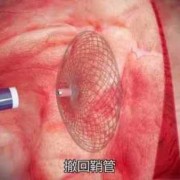 胎儿卵圆孔早闭（新生儿卵圆孔未闭怎么治疗）