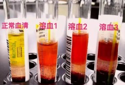 做胎儿溶血检查必须父母都去吗,孕期查溶血多少钱