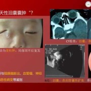 胎儿泪囊囊肿（胎儿泪囊囊肿会自己消失吗）