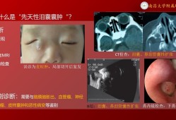 胎儿泪囊囊肿（胎儿泪囊囊肿会自己消失吗）