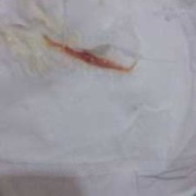 孕妇白带有血丝怎么办,孕中期分泌物有血丝但不出血