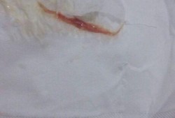 孕妇白带有血丝怎么办,孕中期分泌物有血丝但不出血
