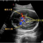 胎儿大脑中动脉意义（胎儿大脑中动脉意义主要看哪个数）