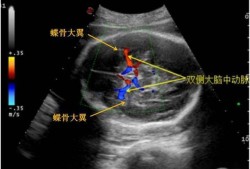 胎儿大脑中动脉意义（胎儿大脑中动脉意义主要看哪个数）