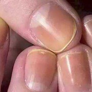 孕期指甲发黄（孕期指甲发黄是什么原因）