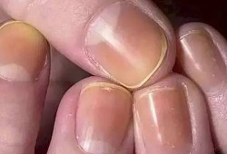 孕期指甲发黄（孕期指甲发黄是什么原因）