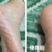 我的脚后跟裂开了，有裂口疼怎么办呢,孕期后脚跟裂了可以擦什么乳效果好