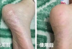 我的脚后跟裂开了，有裂口疼怎么办呢,孕期后脚跟裂了可以擦什么乳效果好