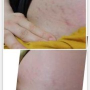 怀孕期间妊娠纹痒怎么办（怀孕期间妊娠纹痒怎么办呢）