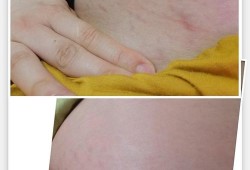 怀孕期间妊娠纹痒怎么办（怀孕期间妊娠纹痒怎么办呢）