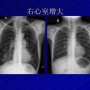 胎儿右心室强光斑（胎儿右心室强光斑是什么意思,严重吗）