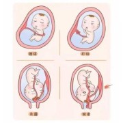 胎儿绕颈一圈怎样改善（胎儿脐带绕颈怎么办）