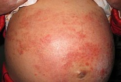 孕期为什么会湿疹（怀孕湿疹是怎么引起的吗？孕妇湿疹可以用什么药吗）
