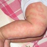 过敏对胎儿有影响吗（孕妇吃虾过敏对胎儿有影响吗）