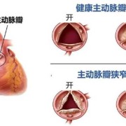 先天性胎儿肺动脉瓣狭窄能要吗,胎儿主动脉瓣狭窄标准