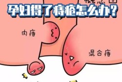 孕期外痔怎么办（孕期得痔疮怎么治疗呢）