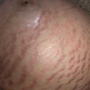 怀孕期间妊娠纹痒怎么办（怀孕期间妊娠纹痒怎么办呢）