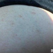 孕期乳房结痂图片（孕期乳房结痂图片）