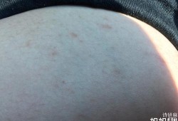孕期乳房结痂图片（孕期乳房结痂图片）