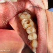 孕期能看牙医吗（孕妇牙洞疼烂到神经了怎么办）