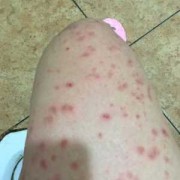 孕期痒疹（孕晚期起痒疹怎么办）