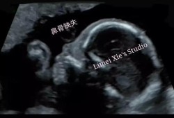 12周胎儿视频（12周胎儿鼻骨缺失是畸形吗）