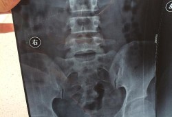 孕期拍片了（孕妇拍了x光怎么办，一次x线对孕早期有什么影响）