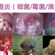 孕期外阴痒怎么办,孕期下面外面瘙痒怎么办