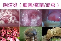 孕期外阴痒怎么办,孕期下面外面瘙痒怎么办