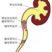 孕期输尿管结石（孕期输尿管结石怎么办）