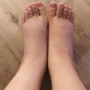 孕妇脚水肿怎么办,孕期脚大了还能恢复吗